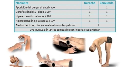 ¿Qué es la hiperlaxitud articular?