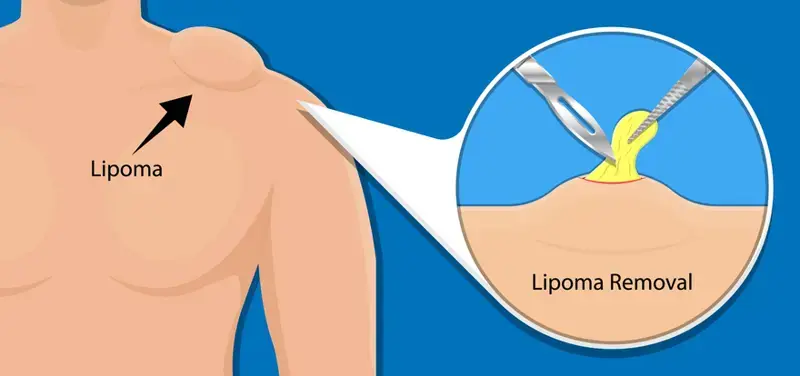 Que es bueno para eliminar un lipoma - Kineplanet