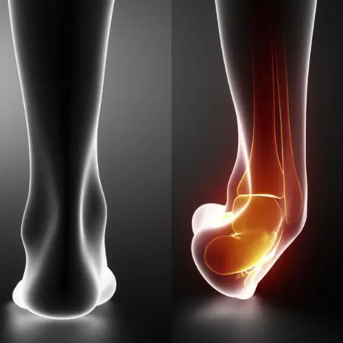 fractura_de_tobillo_dolor_al_andar_en_el_tobillo_doblado