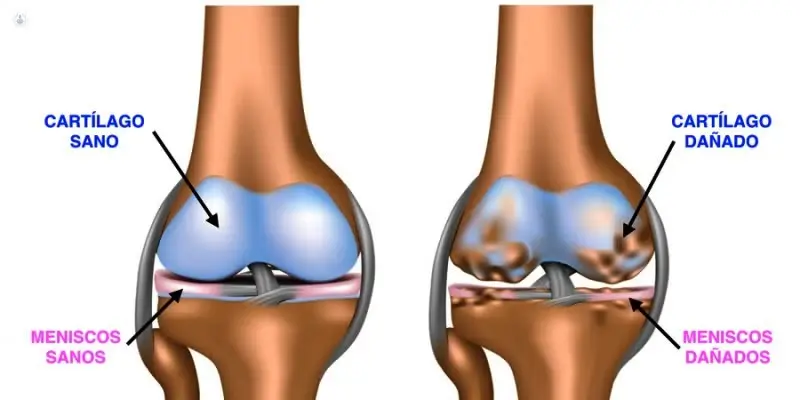 7 Consejos para pacientes con artrosis de rodilla