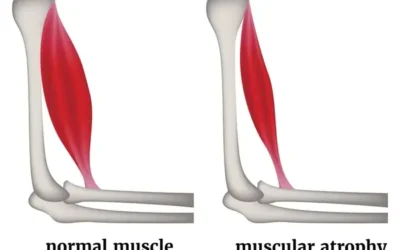 Conoce mas sobre la Atrofia Muscular