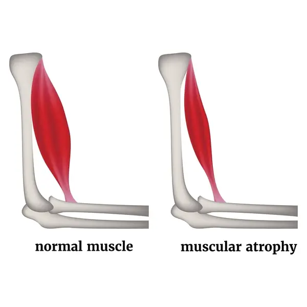 Conoce mas sobre la Atrofia Muscular