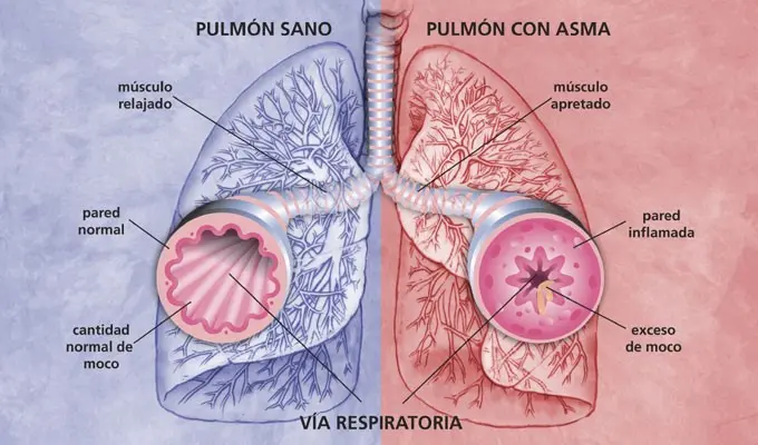 Diferencia de un pulmon sano y uno con asma - kineplanet