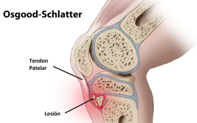 «Osgood-Schlatter: Causa del Dolor de Rodilla»