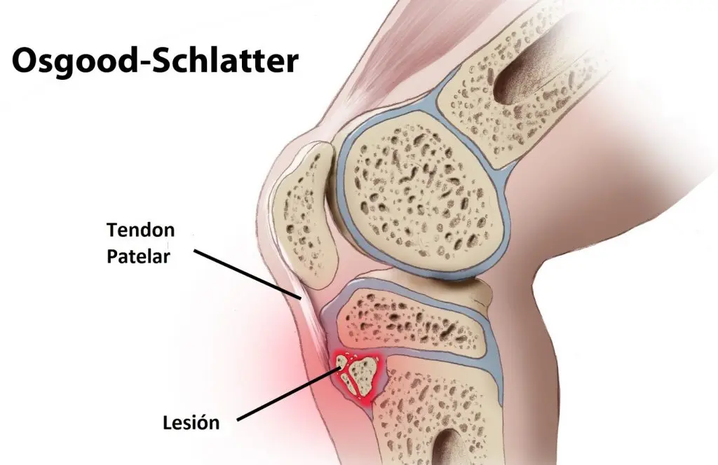 DOLOR DE RODILLAS ¿QUE ES LA ENFERMEDAD DE OSGOOD-SCHLATTER - Kineplanet