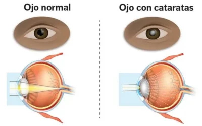 cataratas, la enfermedad que encegue