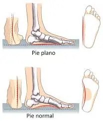 Como Reconocer el pie plano en niños - Kineplanet