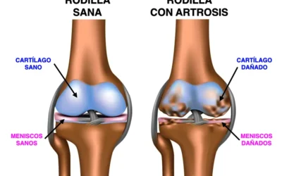 Artrosis en personas mayores: causas, síntomas y tratamiento